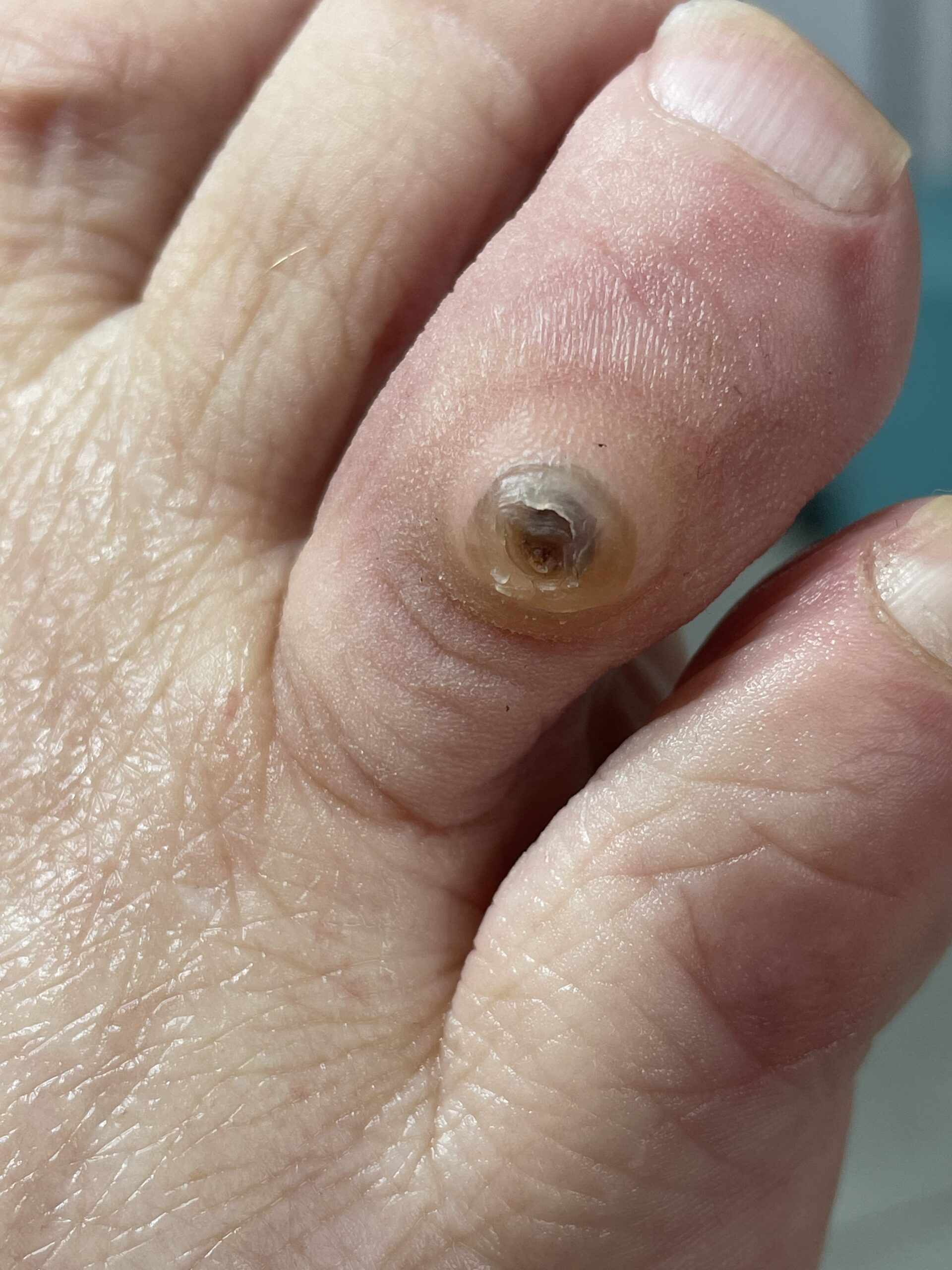 usuniAcie odcisku przed scaled